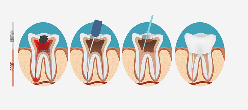 重度の虫歯を治す根管治療