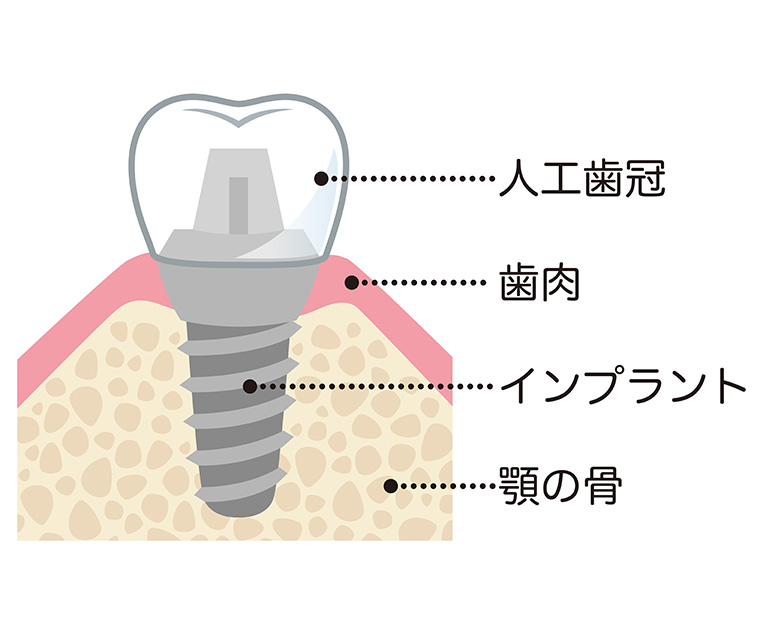 歯周病専門医が行うインプラント治療