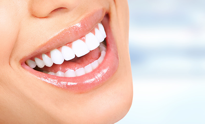 歯並びの矯正は虫歯や歯周病予防につながります