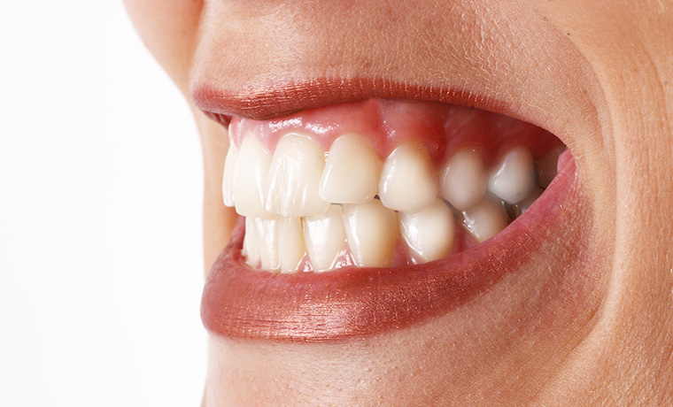 歯ぎしり・食いしばりも歯並びに影響します